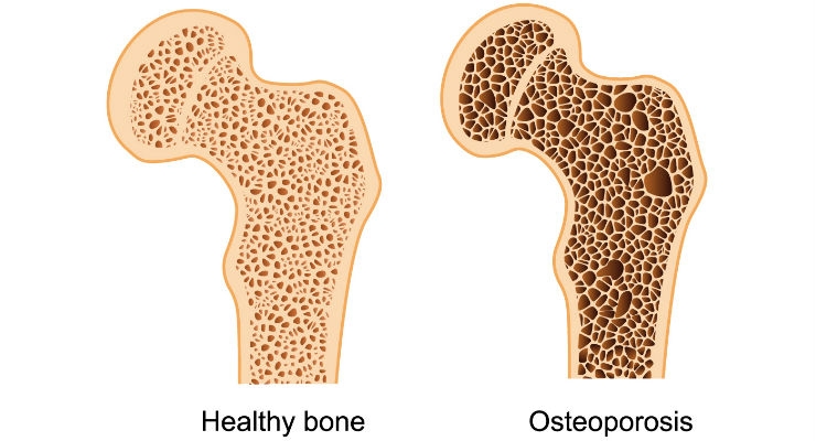 mencegah osteoporosis